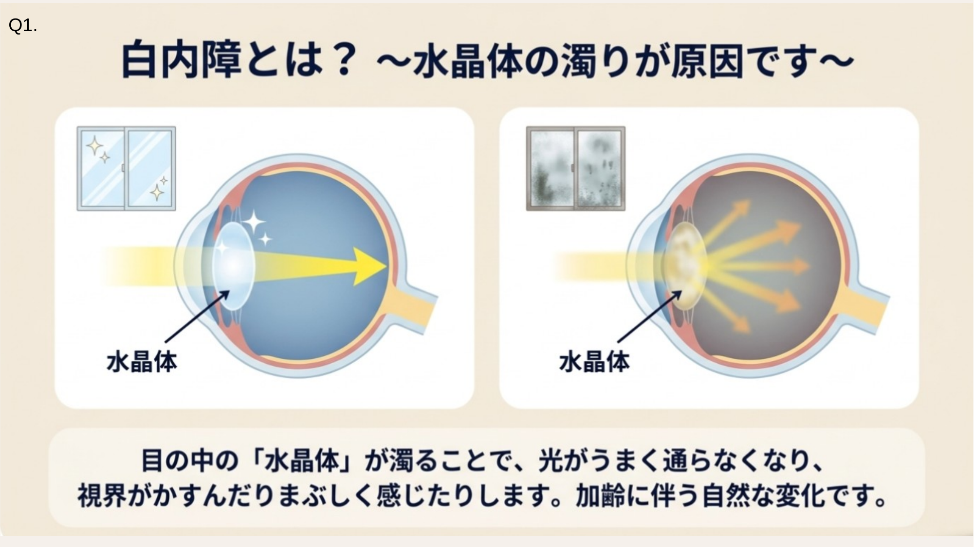 白内障とは — 水晶体の濁りが原因